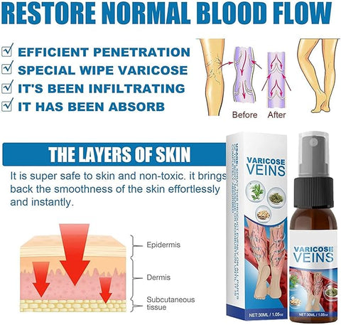 Varicose Veins Treatment