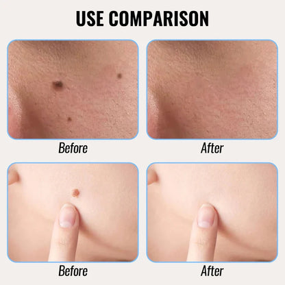 Warts Cure – Remove Warts, Moles & Skin Tags (14 Days Money Back Guarantee)