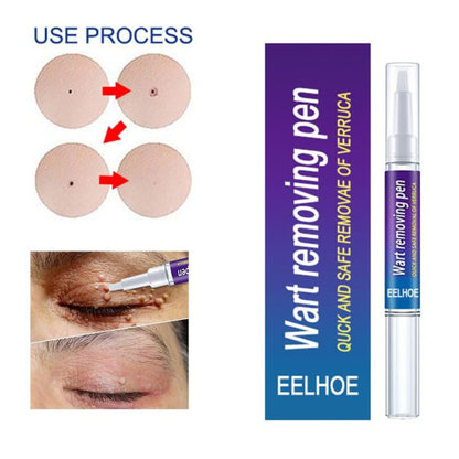 Warts & Moles Remover Pen