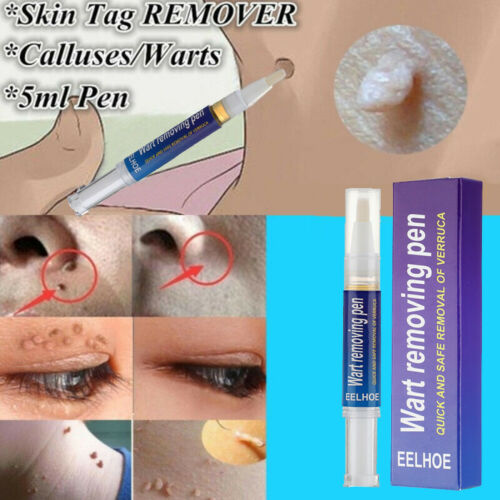 Warts & Moles Remover Pen